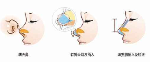朝天短鼻整形手術(shù)價格