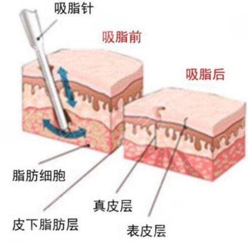 水動力吸脂