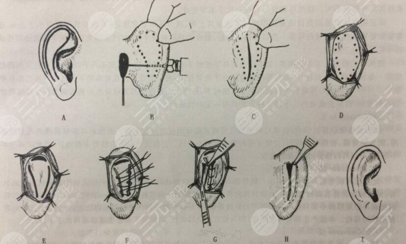 顱耳角在30°-60°之間是一種天生畸形，矯正方法如下