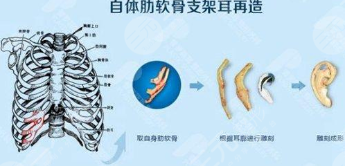 耳再造取軟骨有影響嗎
