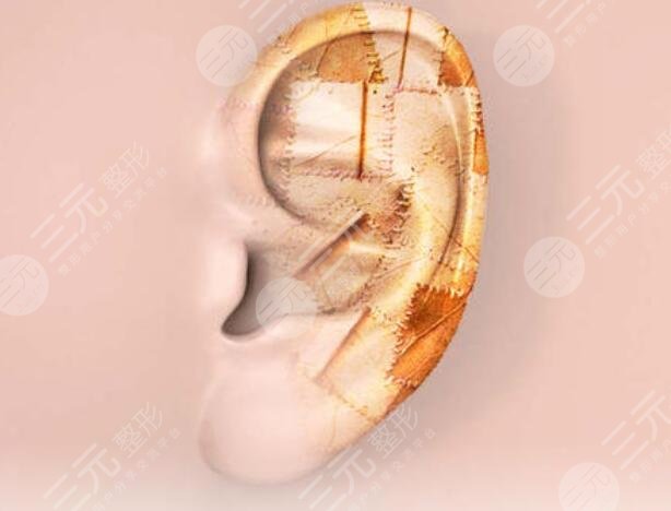 耳再造的方法盤點