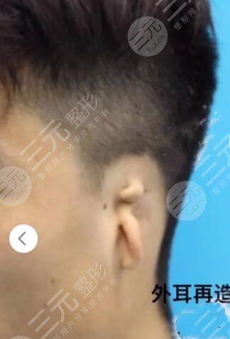 耳再造手術(shù)的注意事項