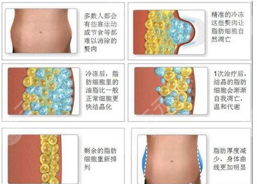 酷塑冷凍減脂的危害