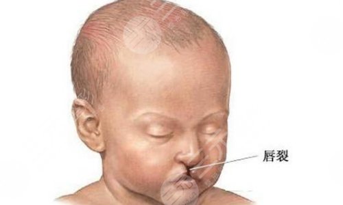 唇腭裂能完全修復(fù)好看不到痕跡嗎？唇腭裂恢復(fù)正常有多難？