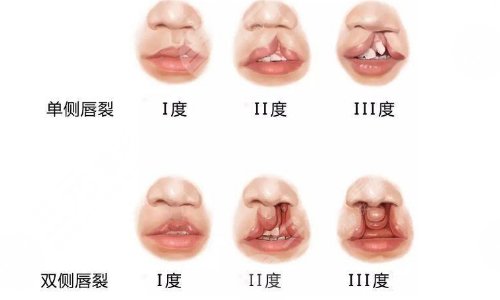 唇腭裂可以完全修復(fù)嗎