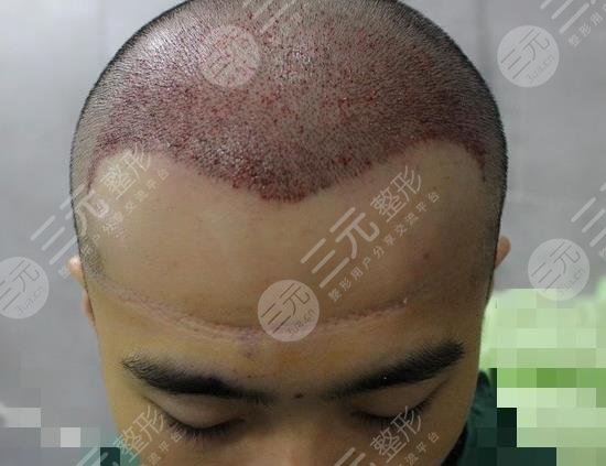 廣州新生植發(fā)醫(yī)院發(fā)際線移植案例分享