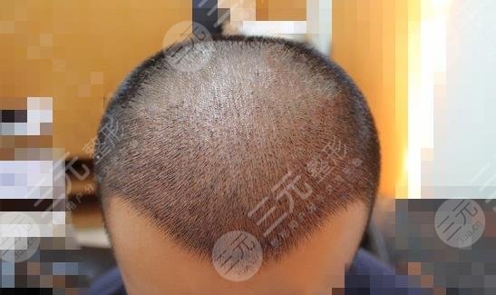 廣州新生植發(fā)醫(yī)院發(fā)際線移植案例分享
