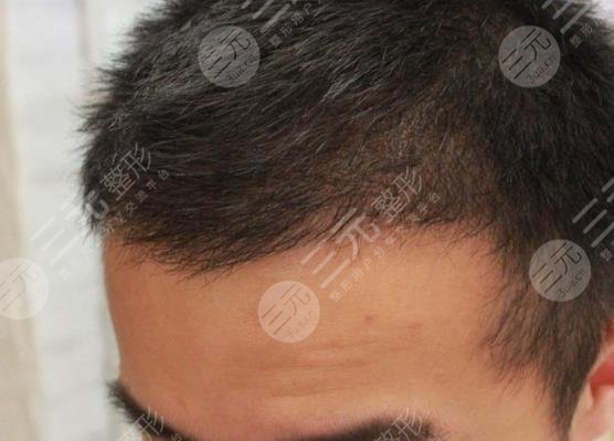 廣州新生植發(fā)醫(yī)院發(fā)際線移植案例分享