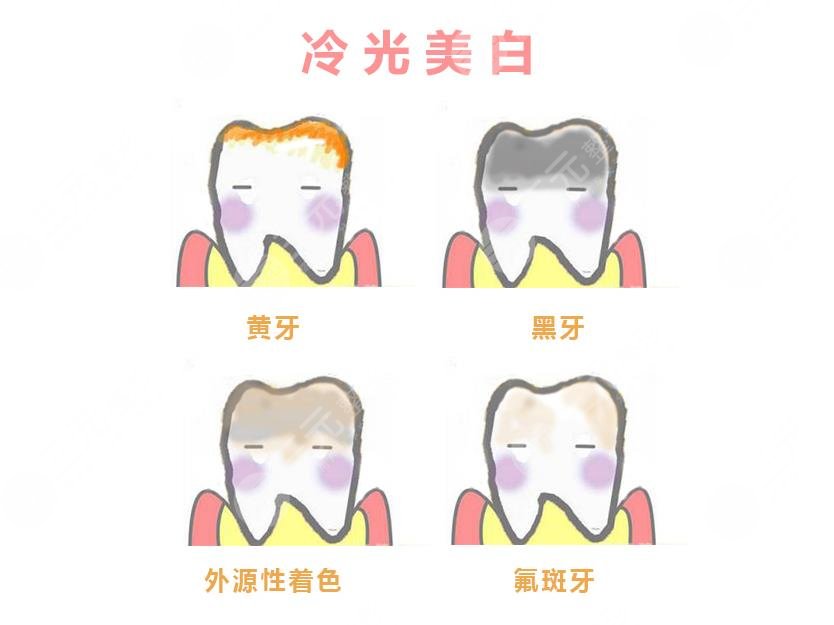 蘇州佳成口腔醫(yī)院牙齒美白相關(guān)介紹