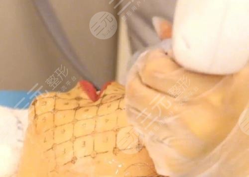 全臉熱瑪吉做一次能維持多久?多少錢?這樣選擇醫(yī)院!