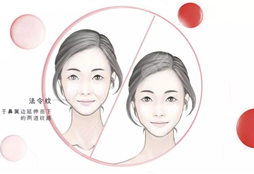 法令紋填充有后遺癥嗎