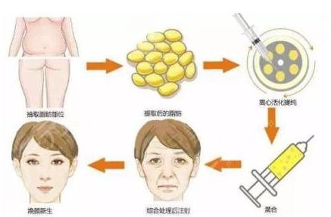 脂肪填充多久能恢復？填充臉部需要多少錢？附價格表+相關介紹