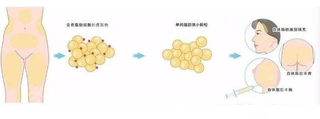 脂肪填充介紹