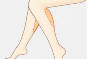 吸脂瘦腿相關科普介紹