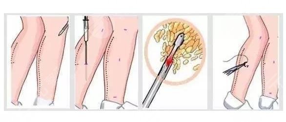 吸脂瘦腿相關科普介紹