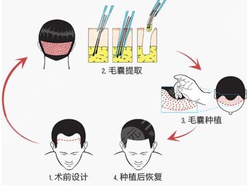 上海九院植發(fā)際線相關介紹