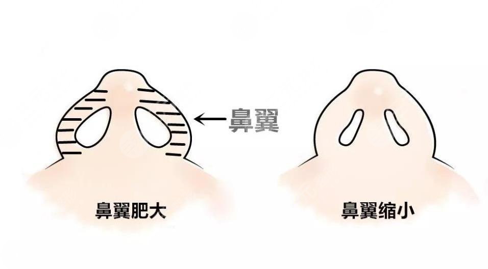 鼻翼太寬怎么整形？鼻翼縮小手術(shù)怎么樣？附鼻部整形價格表