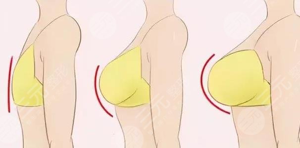 隆胸手術相關介紹