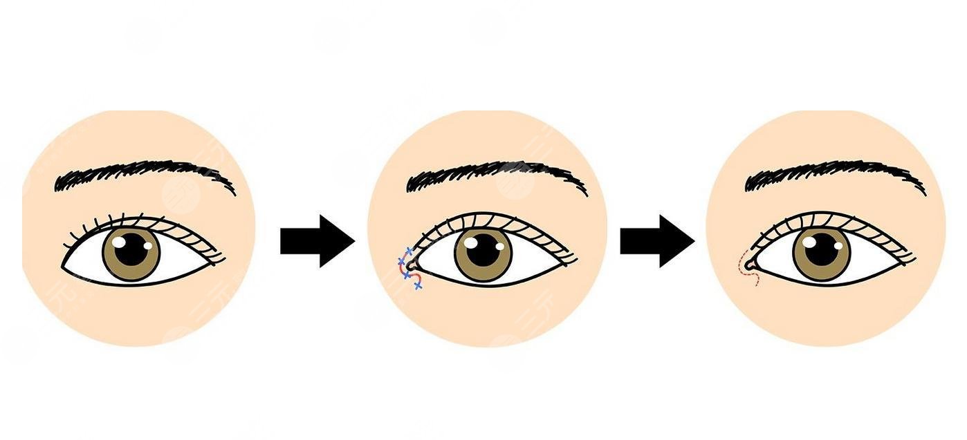 韓勛開眼角疤痕重嗎