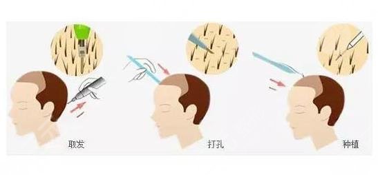 廈門植發(fā)手術(shù)相關(guān)問題科普