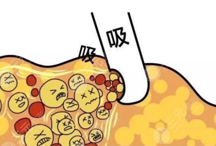 瘦身欄目|超脂塑吸脂有沒有副作用？來看看哪些人不適合做！