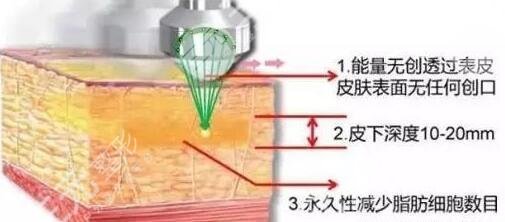 做超脂塑有什么副作用嗎?