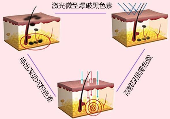 中國(guó)醫(yī)學(xué)科學(xué)院皮膚病醫(yī)院科普祛斑