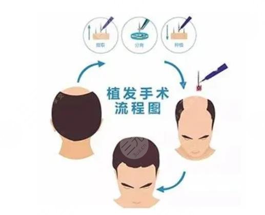 上海九醫(yī)院植發(fā)知識科普