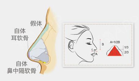 什么是硅膠隆鼻假體取出術(shù)后護(hù)理