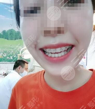 深圳誠(chéng)致美口腔診所牙齒矯正果圖