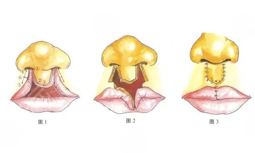 做疤痕修復手術之前需要注意什么