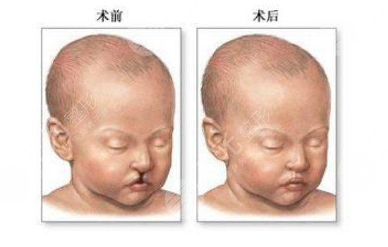 做疤痕修復手術注意事項