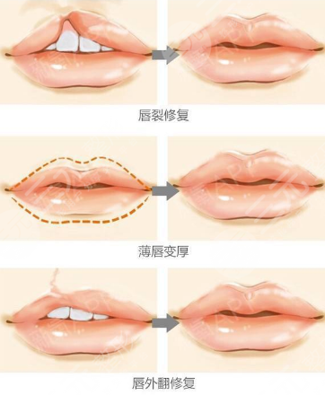 嘴唇修復(fù)手術(shù)一般多少錢