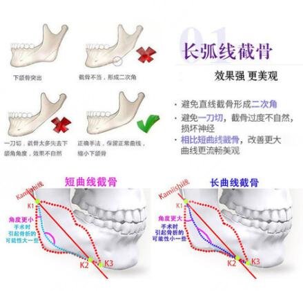 磨骨改臉型手術(shù)過程