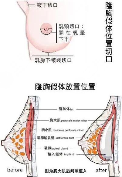 隆胸手術(shù)適合什么人