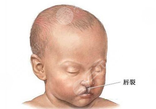 兔唇疤痕修復(fù)的時(shí)機(jī)是什么時(shí)候