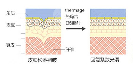 熱瑪吉除皺抗衰操作方式是什么?