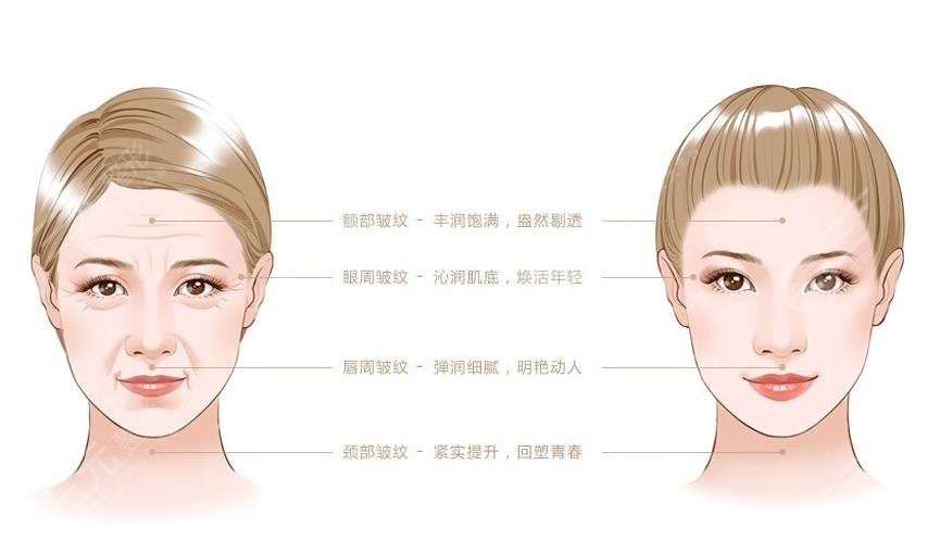 維納斯抗衰儀多少錢一次?原理_作用功_面部抗衰案例果圖來襲!