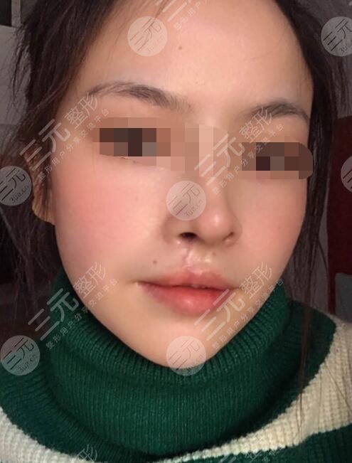 真人做兔唇修復(fù)后3個(gè)月