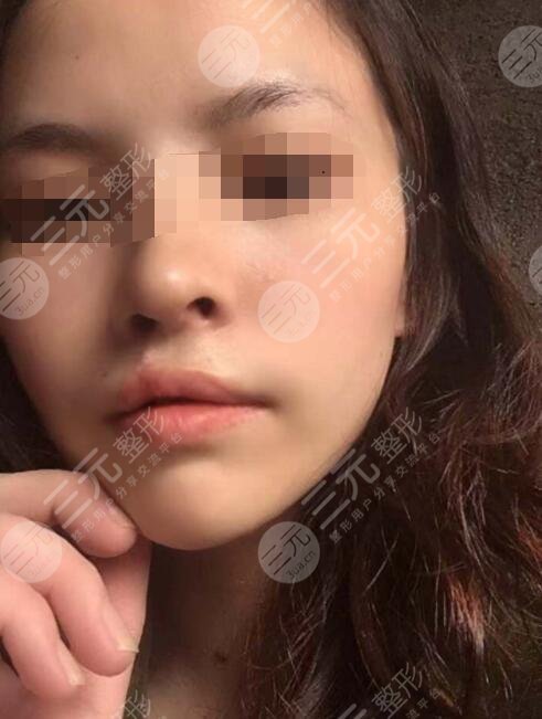 真人做兔唇修復(fù)后6個(gè)月