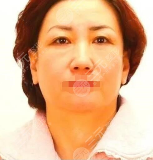 真人中面部抗衰術(shù)前