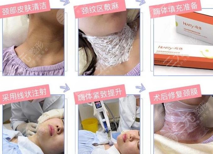 嗨體去頸紋