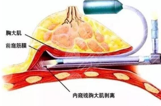 北京昕顏醫(yī)療美容內(nèi)窺鏡隆胸費(fèi)用多少錢