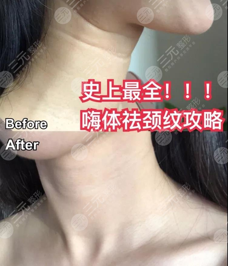 嗨體去頸紋