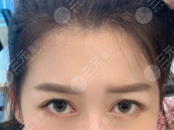 激光除皺后果