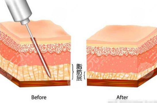 吸脂瘦腿原理