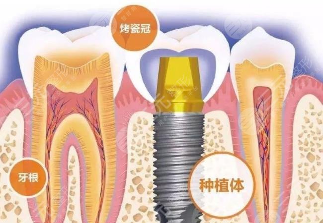 種植牙手術(shù)后的注意事項