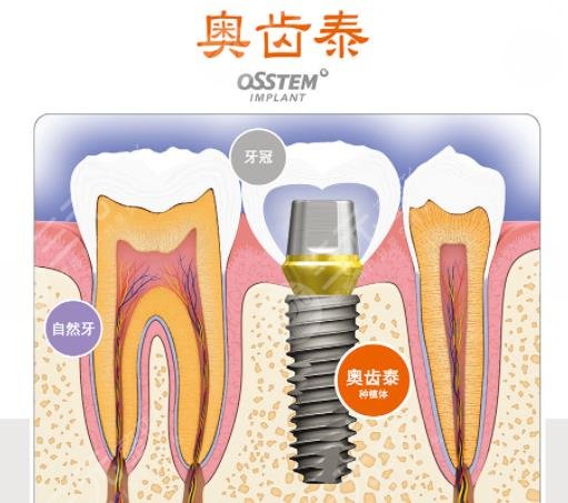 美國種植牙品牌排行榜名稱