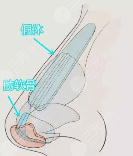 自體軟骨隆鼻降低風險嗎？自體軟骨隆鼻的優(yōu)勢及注意事項，姐妹們學起來！