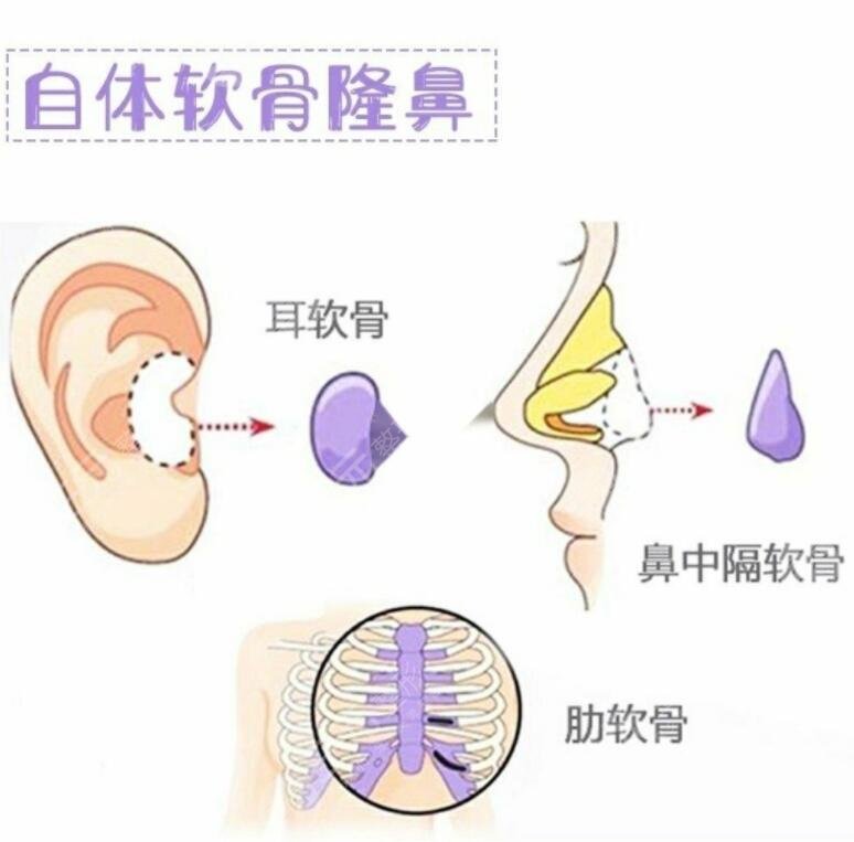 自體軟骨隆鼻降低風險嗎